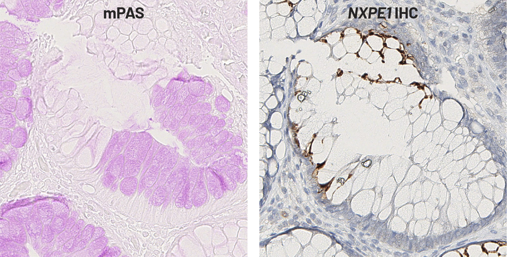 The role of NXPE1 in mild periodic acid Schiff (mPAS) staining is exquisitely illustrated in these images. They capture a human colonic crypt generated by the extremely rare fusion of two stem cells with distinct genotypes for the NXPE1 gene. mPAS (left) stains one half of the crypt pink, due to a lack of modification to sialic acids, but fails to stain the other. This is because one half is NXPE1-positive, while the other is negative, as shown in the IHC-staining for the NXPE1-encoded protein (right).
