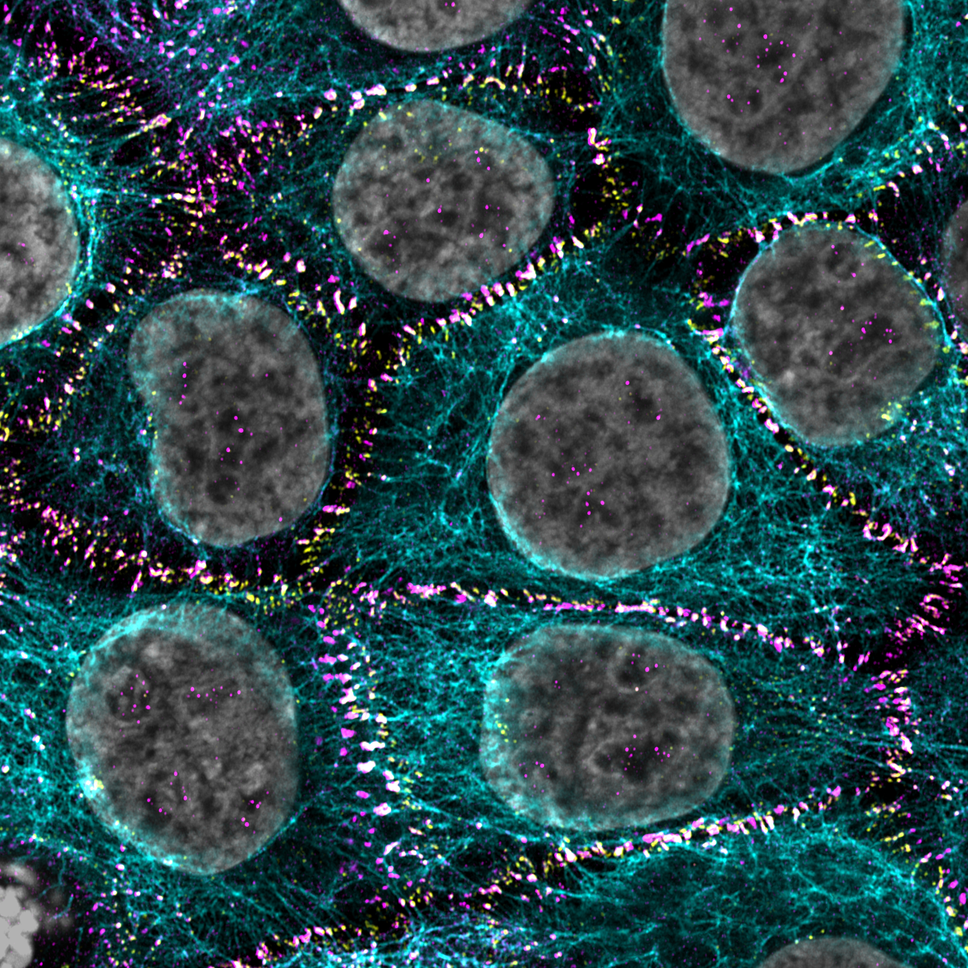 A monoculture of keratinocytes (cyan and gray) linked by desmosomes (green and purple). Mutations in desmosome genes, seen in 70% of cutaneous melanoma tumors, occur in keratinocytes and inhibit their expression. Desmosome deficiency in keratinocytes boosts the proliferation of adjacent melanoma cells in culture, adding to evidence that mutations in nontumor cells can contribute to neoplastic transformation.