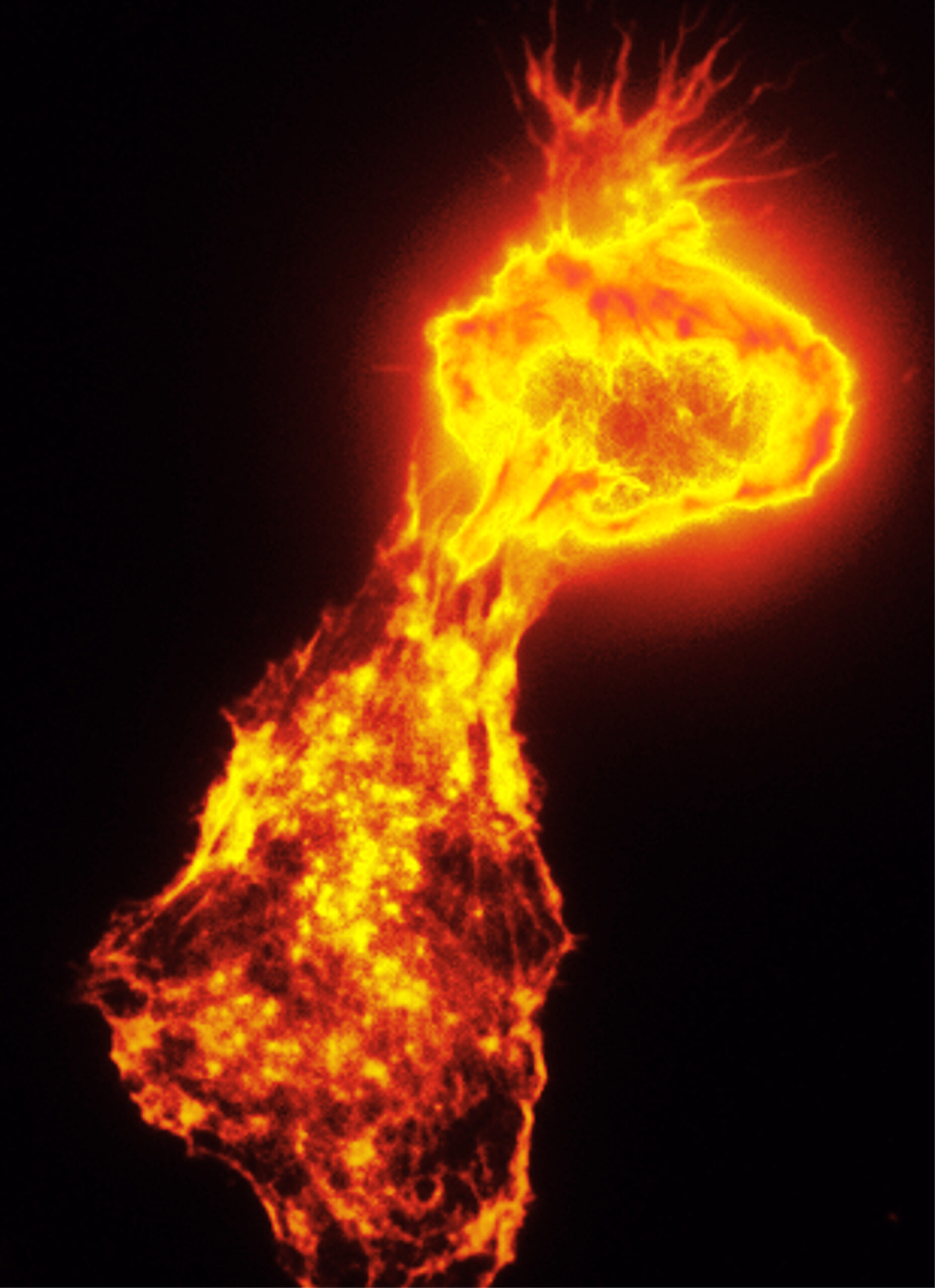 Phagocytosis of a cancer cell (top) by a macrophage (bottom), captured by high-resolution fluorescent microscopy. Stereotactic body radiotherapy (SBRT) aimed at a single tumor can accelerate the growth of distant metastases. SBRT induces the expression of growth factor amphiregulin, which reprograms EGFR-expressing myeloid cells into an immune-suppressive state and increases tumor expression of CD47, a “don’t-eat-me” signal transmitted to macrophages. F-actin was visualized by phalloidin staining for this image.