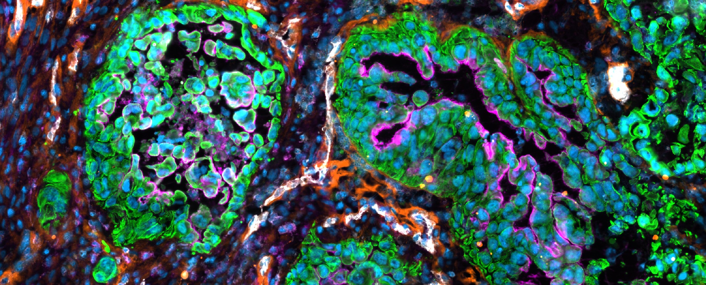Micrograph showing the diversity of interacting cell types in the microenvironment of a brain metastasis. CD13 (pink) is enriched in cancer cell nests (pan-cytokeratin, green) located in proximity to the tumor vasculature (endothelial cells, white, and stromal cells, orange). All nuclei are visible in blue (DAPI staining).