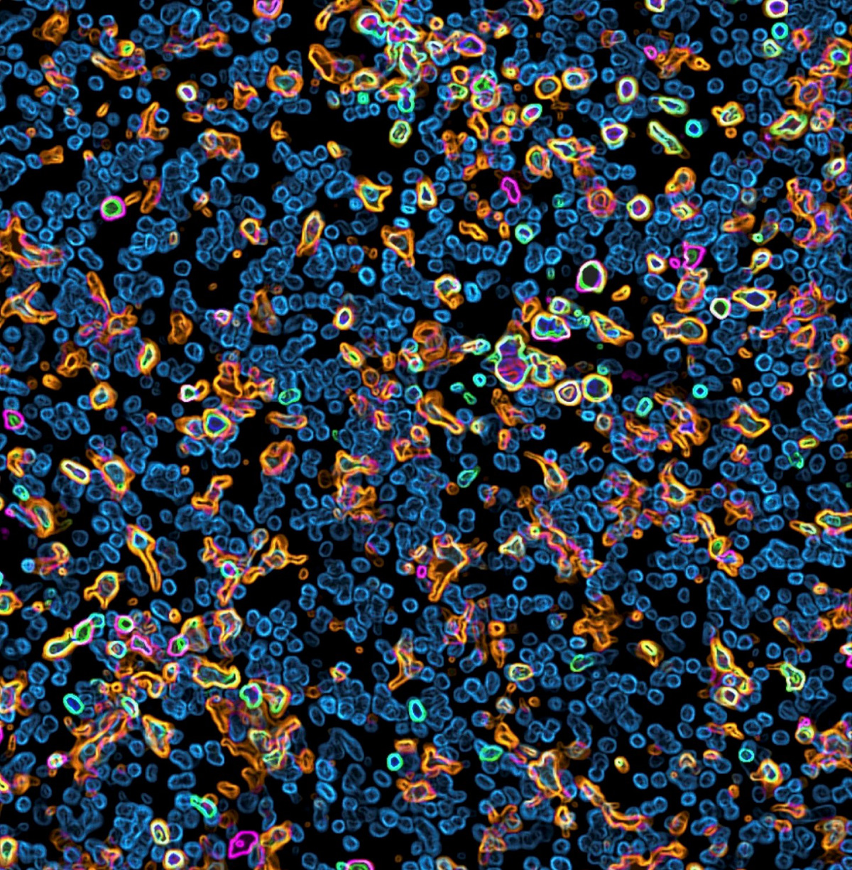 Image rendering of the glioma microenvironment following ADAR1 deletion, showing cancer cells (blue) and infiltration of immune cells (green), including CD8+ T lymphocytes (green+pink) and tumor-associated macrophages (green+orange).