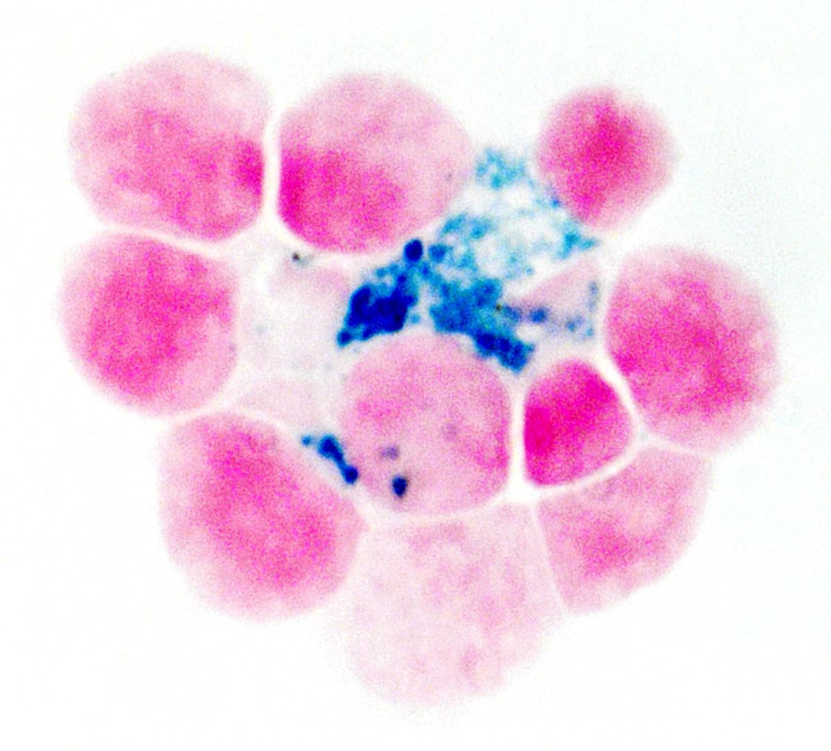 Upon metastasizing to the bone marrow, tumor cells hijack EBI macrophages, diverting iron from erythroblasts to tumor cells, contributing to anemia. This bright-field image of Prussian blue and nuclear fast red staining shows erythroblasts around an iron-rich, blue-stained macrophage.