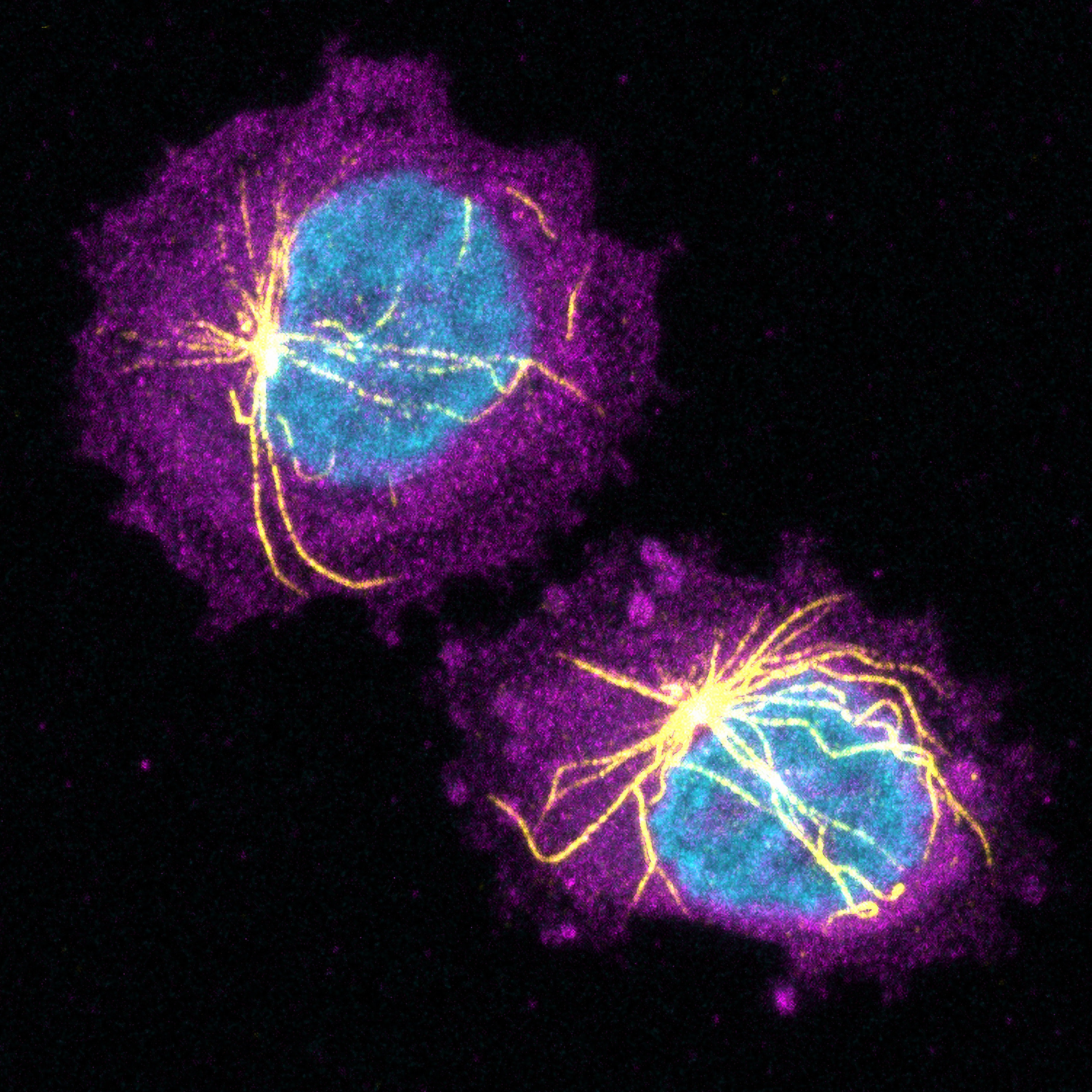 Researchers led by Ludwig Oxford’s Richard White and Miranda Hunter of the Memorial Sloan Kettering Cancer Center have discovered that the tight physical confinement of tumor cells by surrounding tissues has epigenetic consequences that can influence melanoma progression. Rather than continuing to divide rapidly, squeezed cancer cells in such circumstances activate a program of ‘neuronal invasion’ and spread into neighboring tissues. Aside from fleeing, confined melanoma cells also build a cytoskeletal cage (yellow) around their nuclei (blue) that helps protect the nucleus from rupture and DNA from damage caused by confinement-induced stress.