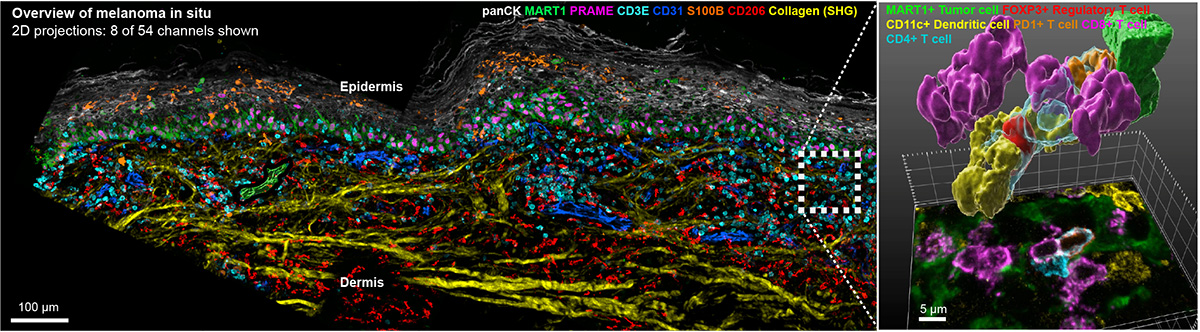 Left: High-resolution view of early melanoma from a FFPE patient sample stained by 3D CyCIF for 54 proteins (only 8 shown) in a 35-micron thick tissue specimen. Right, top: Inset shows a community of immune cells interacting with a tumor cell. Thick tissue imaging paired with 3D high-resolution confocal microscopy resolves the full shape of each cell and its contacting neighbors along all 3 axes. Right, bottom: A 2D image simulated below for comparison.