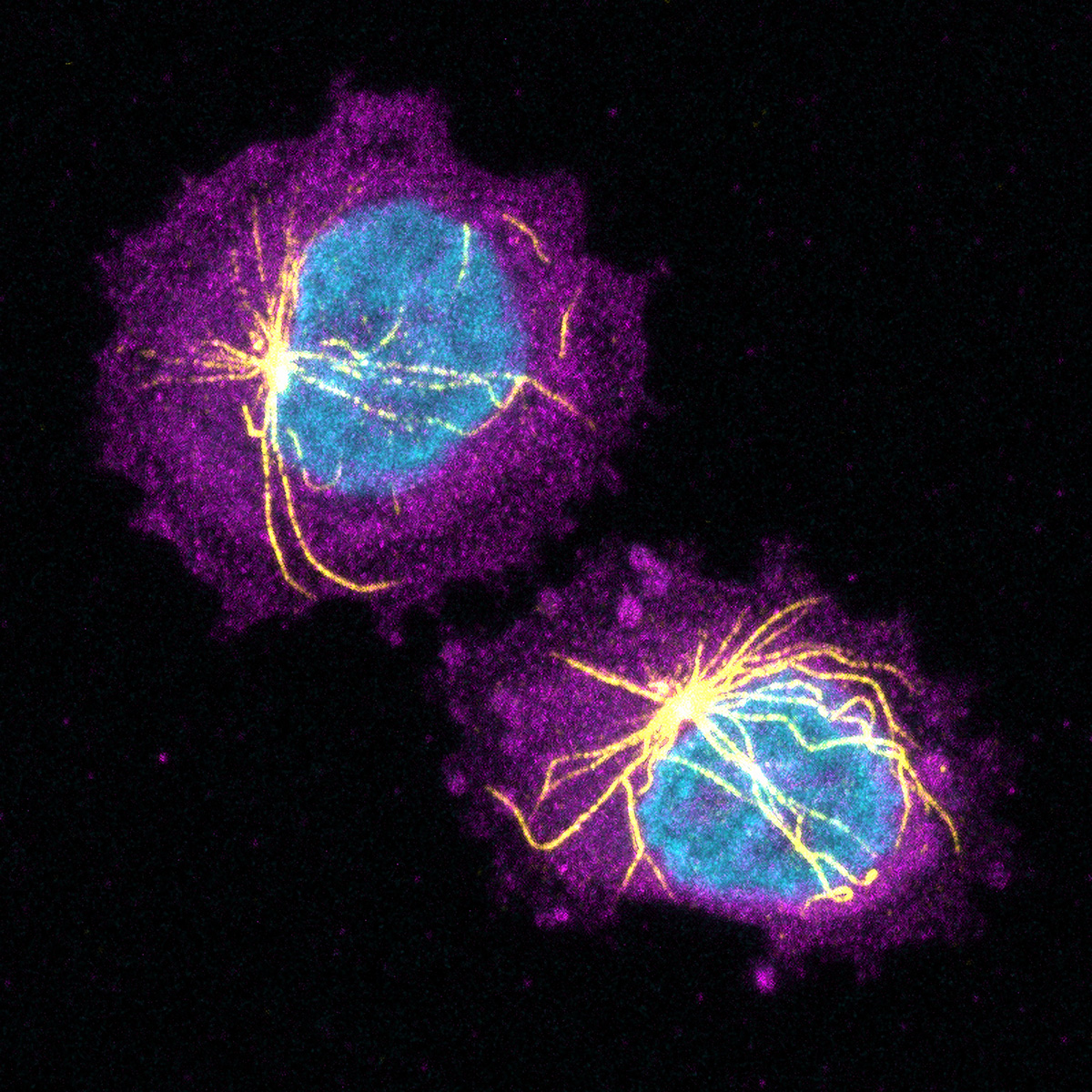 Researchers led by Ludwig Oxford’s Richard White and Miranda Hunter of the Memorial Sloan Kettering Cancer Center have discovered that the tight physical confinement of tumor cells by surrounding tissues has epigenetic consequences that can influence melanoma progression. Rather than continuing to divide rapidly, squeezed cancer cells in such circumstances activate a program of ‘neuronal invasion’ and spread into neighboring tissues. Aside from fleeing, confined melanoma cells also build a cytoskeletal cage (yellow) around their nuclei (blue) that helps protect the nucleus from rupture and DNA from damage caused by confinement-induced stress.