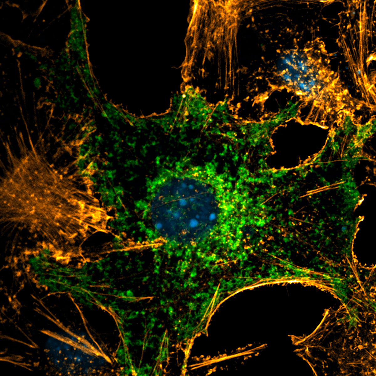 Fluorescence microscopy image of lymph node metastatic melanoma cells, showing ferroptosis suppressor-1 (FSP1) in green, cytoskeletal actin filaments in orange, and cell nuclei in blue.