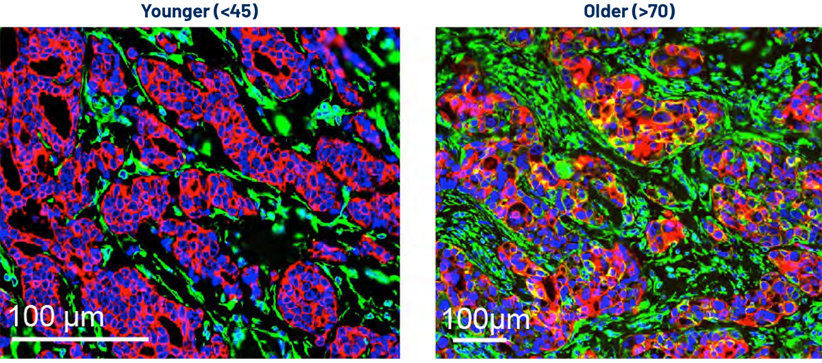 Representative composite images of TNBC tumor tissue sections from a younger (70) patient stained for panCK (red) and vimentin (green). Nuclei are stained with DAPI (blue). Colocalization of vimentin+/panCK+ cells is indicated in yellow, revealing epithelial–mesenchymal transition, which is increased in older patients.