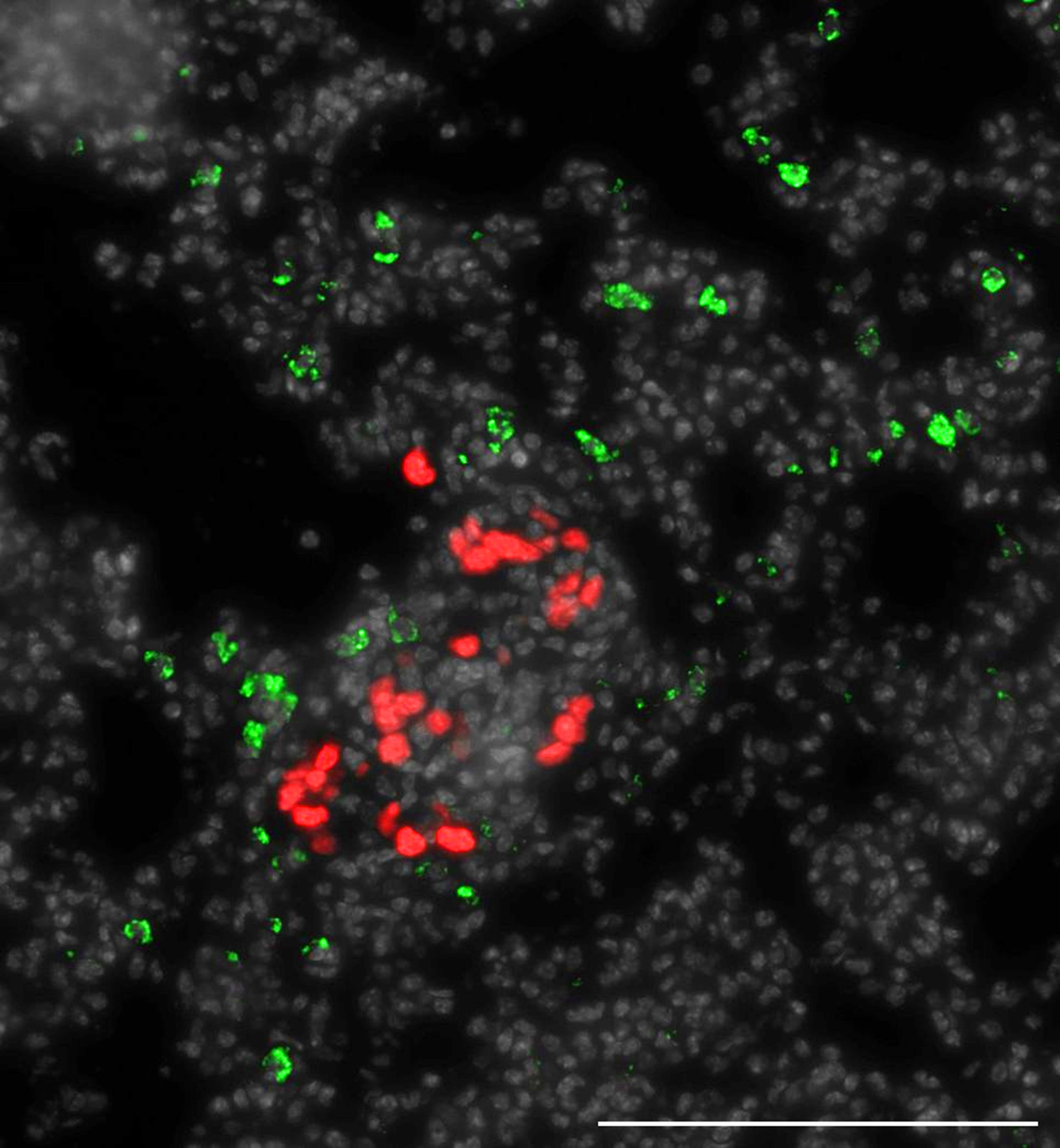 Image of a micrometastasis of triple-negative breast cancer in the lung, showing disseminated tumor cells (red) and immune cells (NK cells and CD8+ T cells, green).