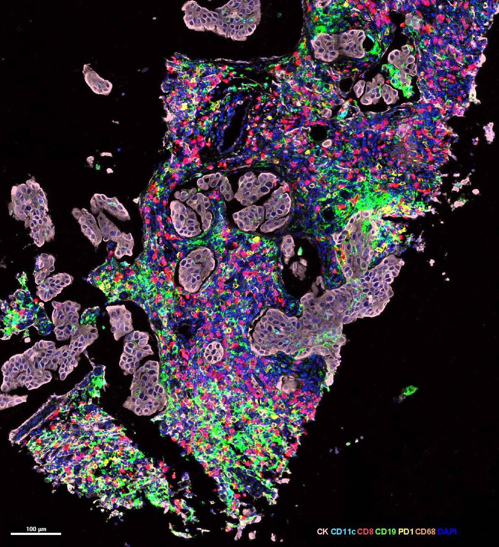 Micrograph of a section from a high-grade ovarian cancer metastasis.