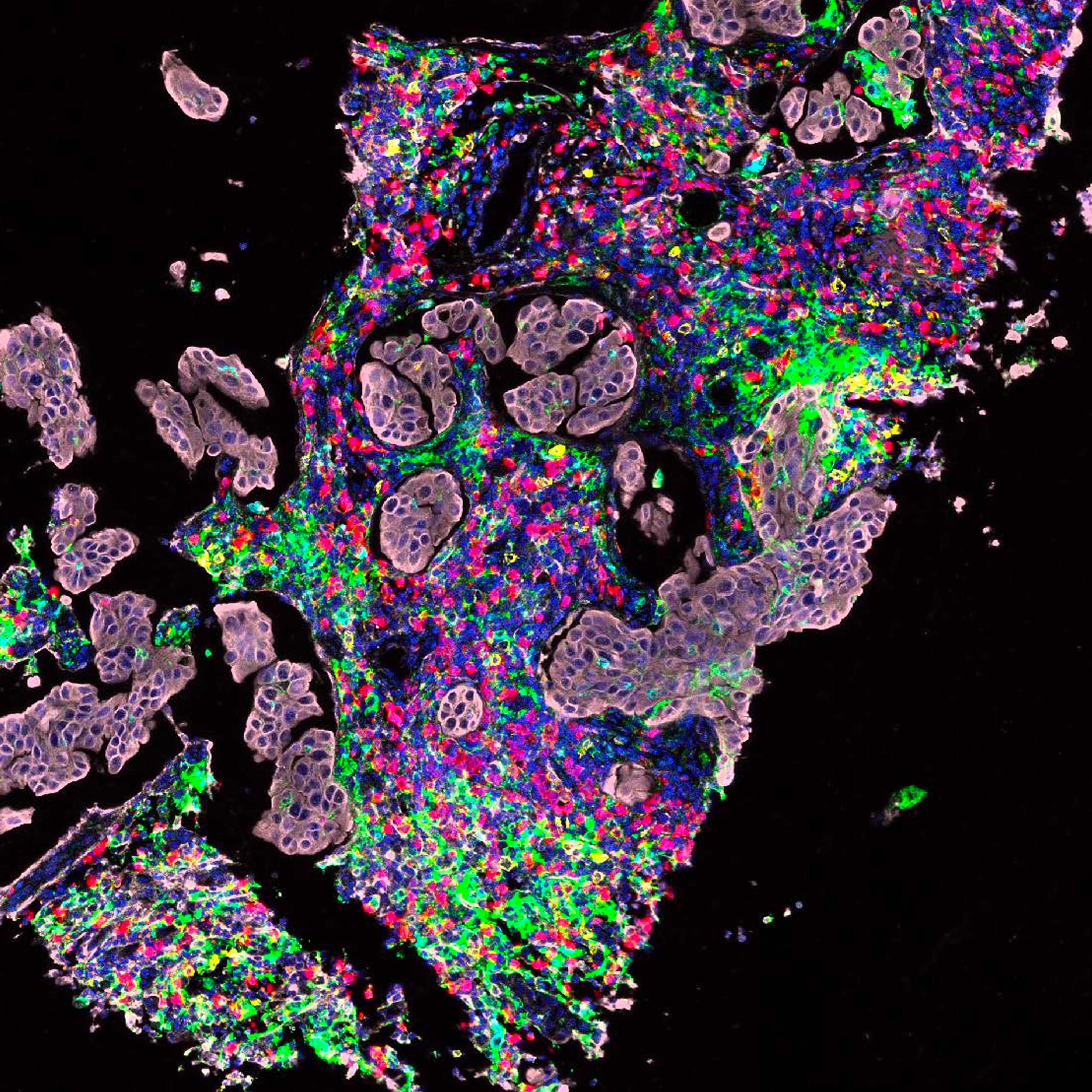 Micrograph of a section from a high-grade ovarian cancer metastasis.