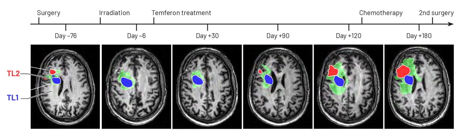 The MRI scans show the evolution of GBM over time in a patient treated with Temferon. After partial surgical resection, the largest target lesions (TL) remaining were TL1 (blue) and TL2 (red). The light green areas are perilesional edema. TL2 disappeared after radiotherapy, while TL1 was radioresistant. Over time, TL1 remained stable, and a biopsy revealed a high frequency (16% of TAMs) of TIE2+ macrophages (TEMs) and the presence of a strong interferon response signature, consistent with infiltration of Temferon progeny and activation of the TIE2 promoter-driven IFN-α transgene. The opposite was true for TL2, which recurred at 3 months and continued to grow.