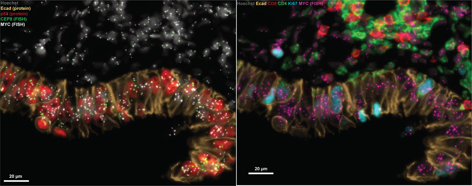 A precursor lesion (STIC) shows early genetic changes and immune engagement using ORION-FISH. Left: This STIC lesion (a precursor of HGSOC) shows p53 protein overexpression (red), confirming a p53 mutation, along with extra copies of the MYC gene (white). E-cadherin (brown) marks the epithelial cells, confirming that the MYC gain occurs specifically within the STIC lesion itself. Right: Surrounding the STIC epithelium (which carries the MYC gain), immune cells—including CD8 (red) and CD4 (green) T cells—are enriched in close contact with the lesion.