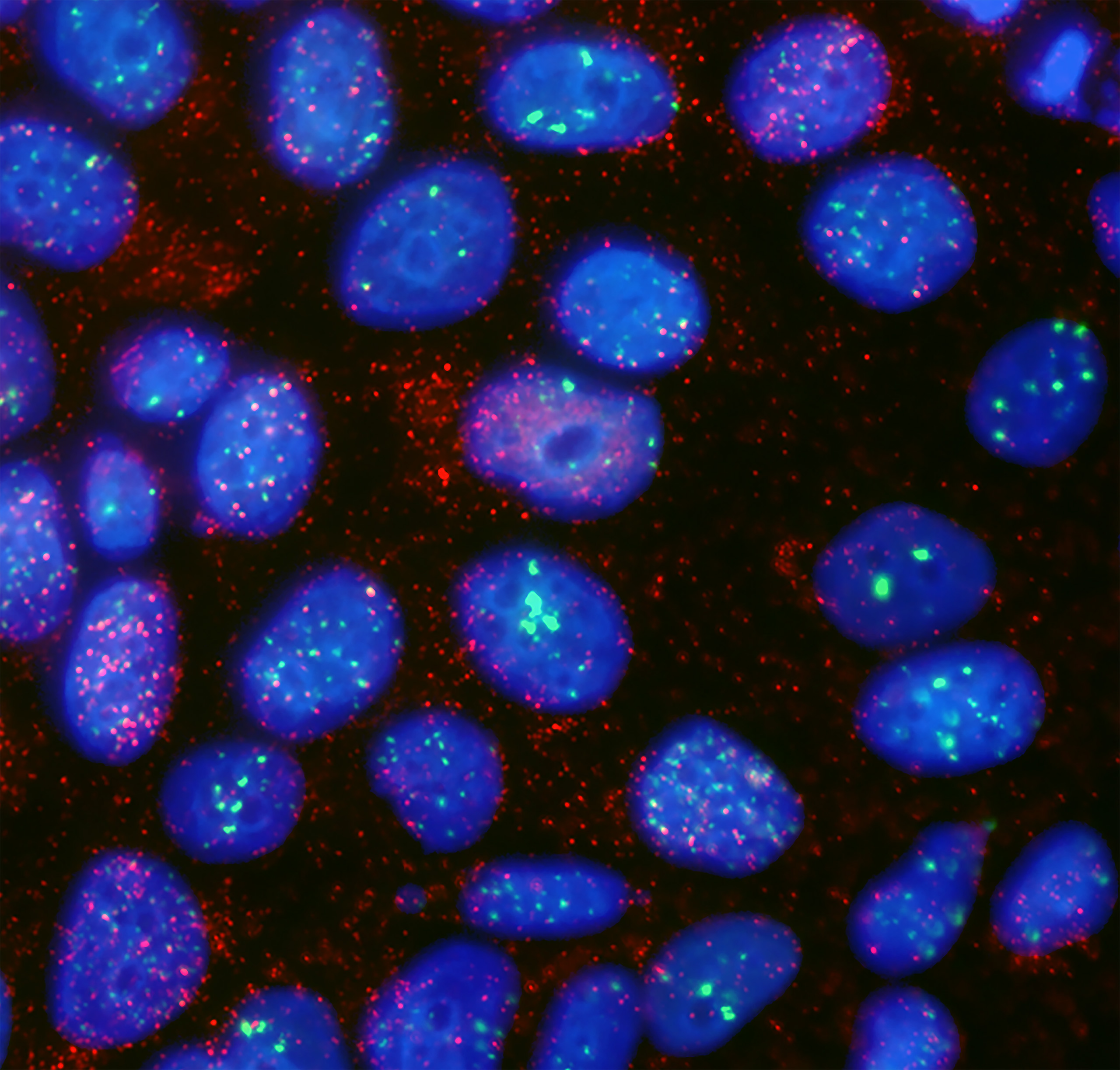 This image shows MCF7 breast cancer cells 24 hours after irradiation in the presence of the PARP inhibitor veliparib.
