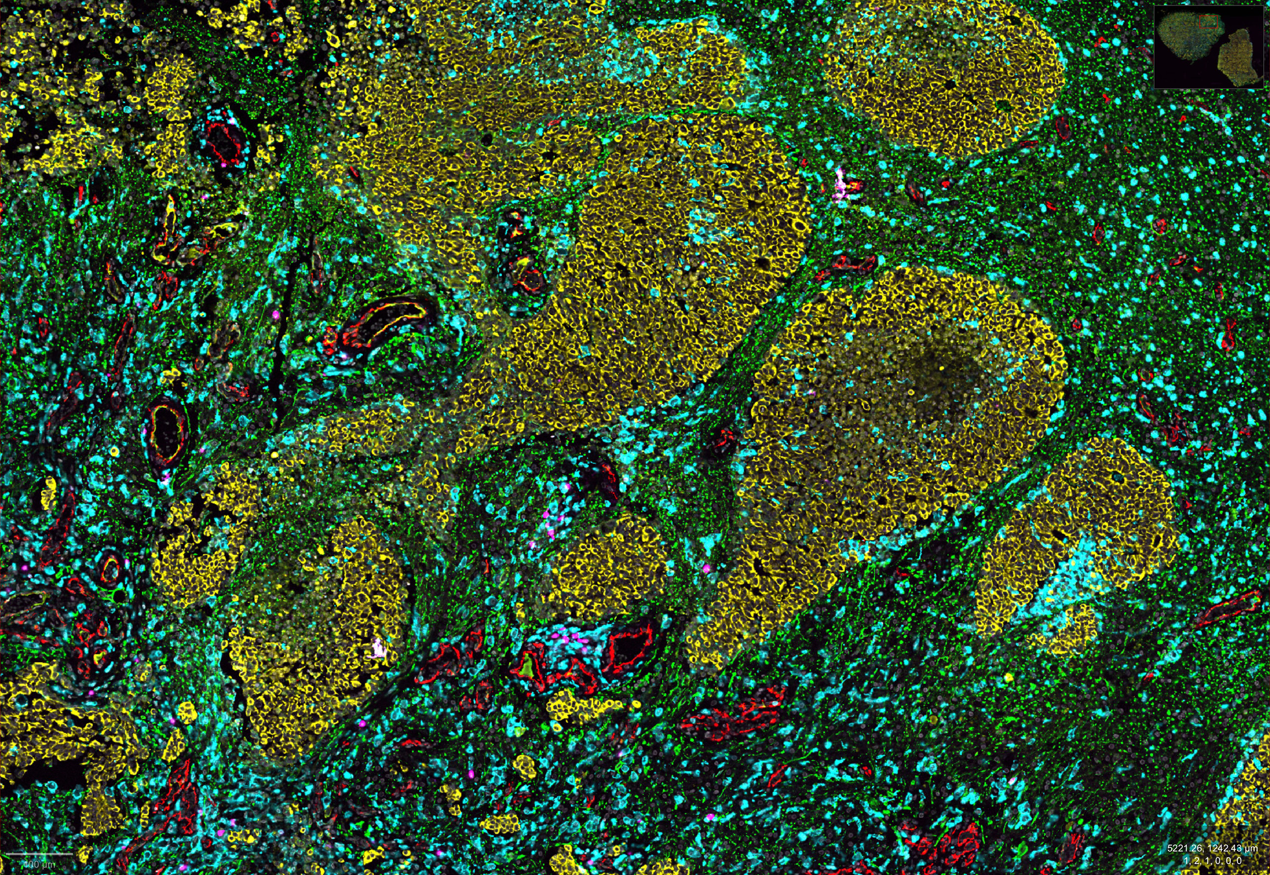 This is a CODEX image of a breast cancer brain metastasis derived from an autopsy.