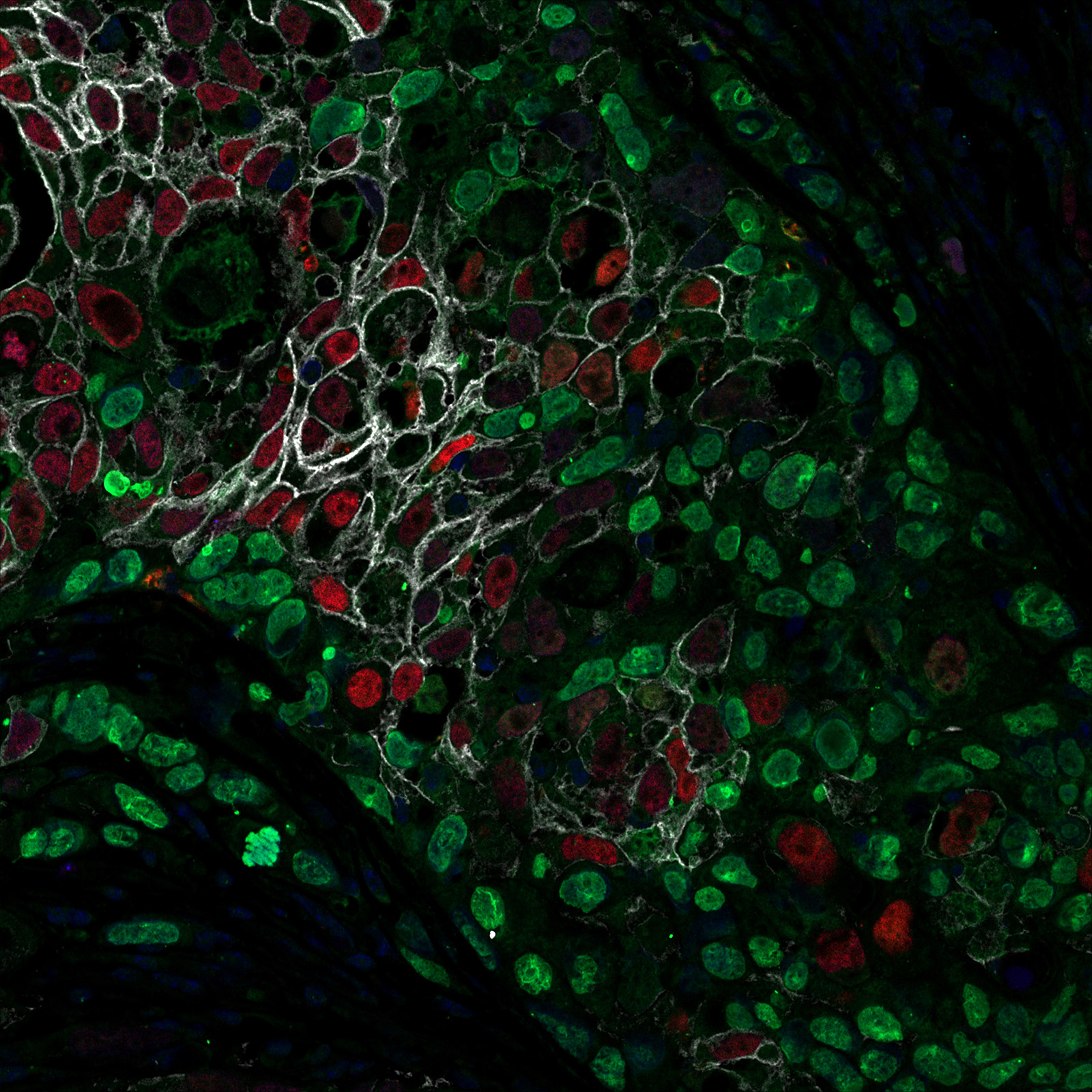Micrograph of a HER2 heterogeneous tumor. Red and green are HER2 high and low cells, respectively, marked with RFP and GFP, and white is HER2 staining.
