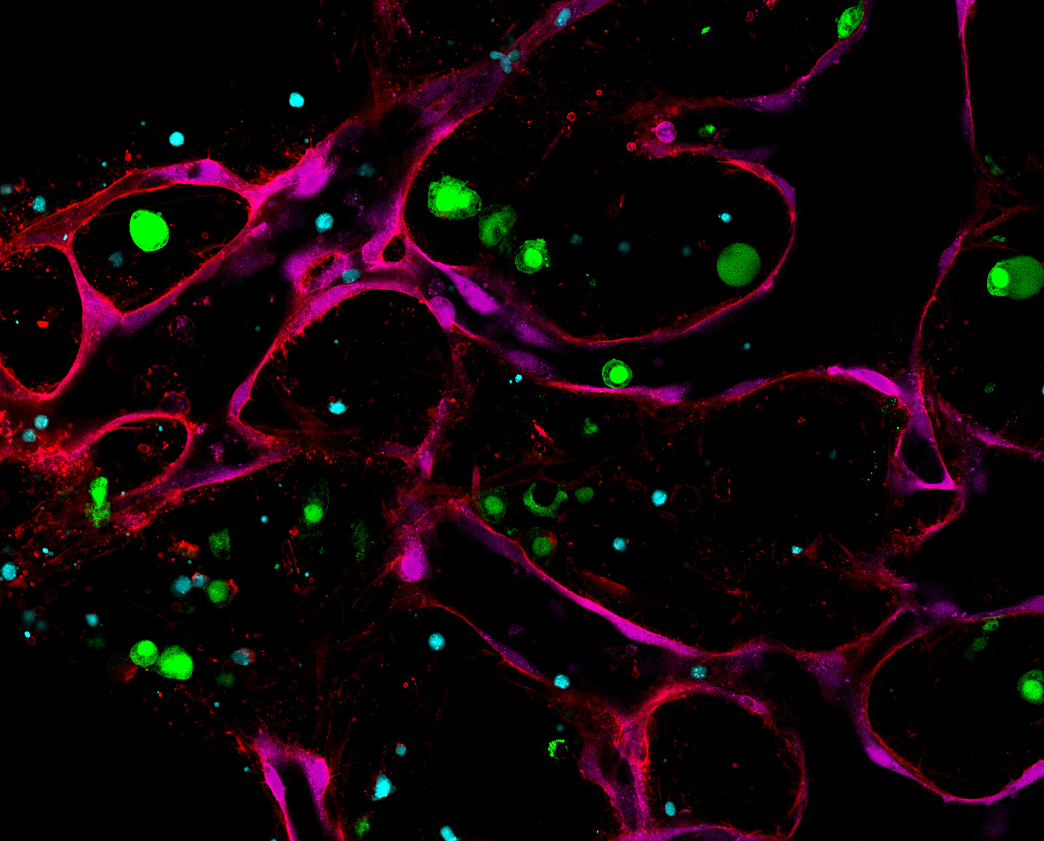 This image shows a 3D in vitro MM-on-chip model that recapitulates hallmarks of the MM tumor microenvironment and is used here to investigate CAR-T cell responses against MM.